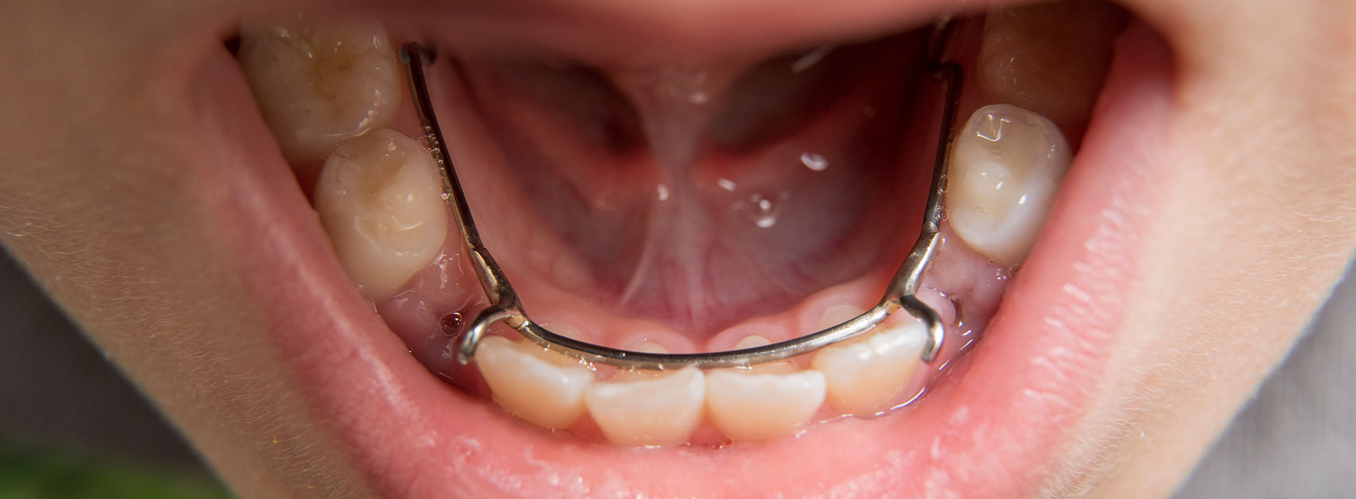 A person s mouth with teeth showing, displaying a surgical palate repair, featuring metal brackets and wires.