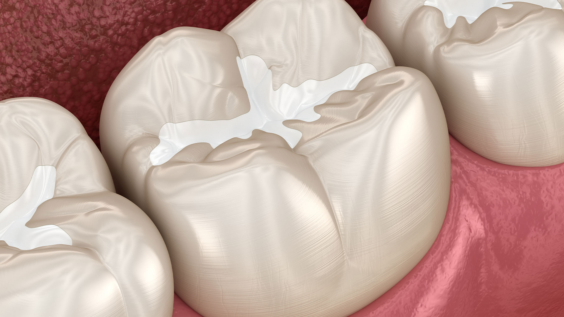 The image shows a collection of white dental implants with a golden hue, placed on a red surface, possibly for display or sale purposes.