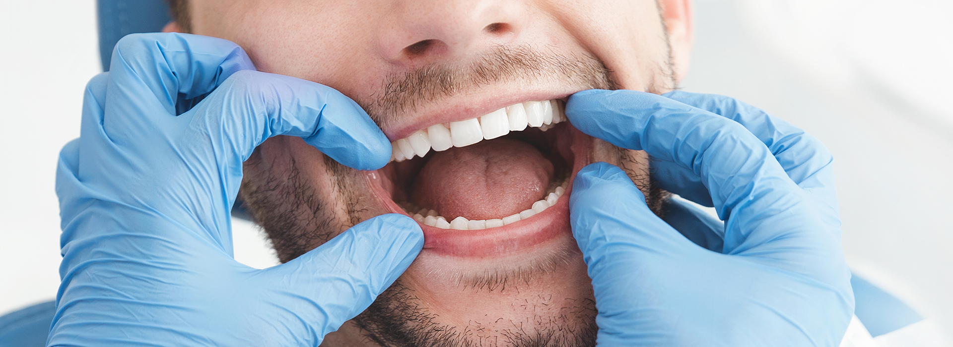A man with his mouth open, being examined by a dental professional wearing blue gloves.